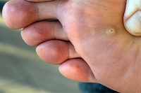 Types and Symptoms of Plantar Warts