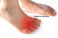 Causes and Pain of Morton’s Neuroma