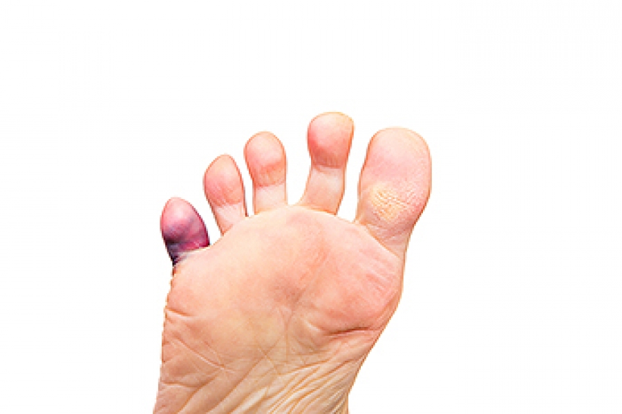 Why Does My Pinky Toe Hurt When I Wear Shoes? Understanding Causes and Solutions