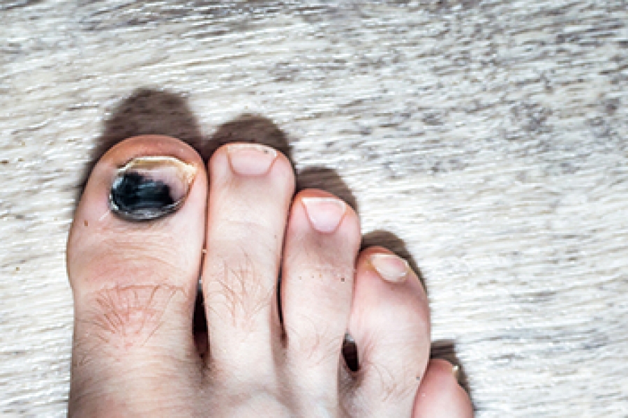 What Are The Causes of Having Thick Toenails